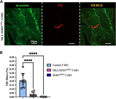 Sympathetic neuropathology is revealed in muscles affected by amyotrophic lateral sclerosis